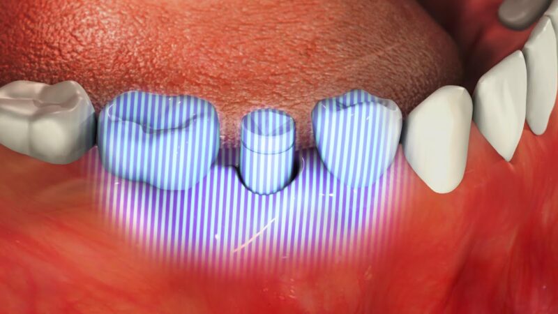 CADCAM-Abutment-with-SICvantage-max-Dental-Implant