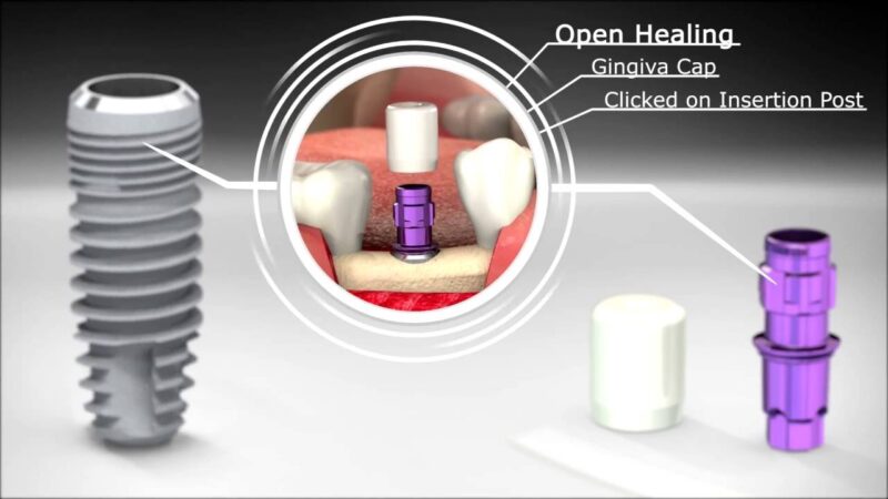 Dental-Implant-SICvantage-max-Conical-Innovation