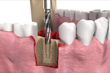 SIC-invent-Dental-Implant-Procedure-SICmax-implant-insertion