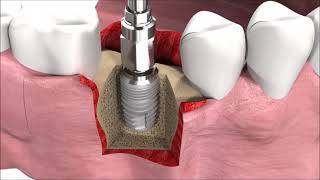 SIC-invent-Dental-Implant-Procedure-SICmax-implant-insertion