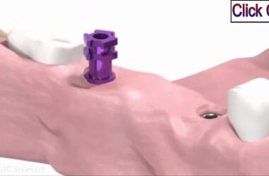 SIC-invent-Dental-Implant-Prosthetic-Animation-Bridge-Work