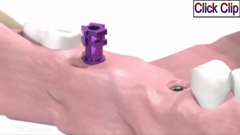 SIC-invent-Dental-Implant-Prosthetic-Animation-Bridge-Work
