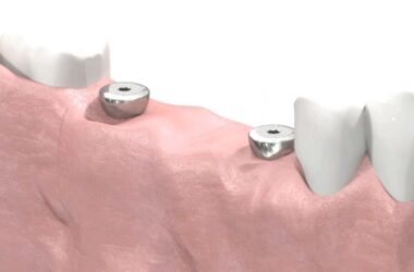 SIC-invent-Dental-Implant-Prosthetic-Animation-Bridge-Work-Open-Tray-Technique