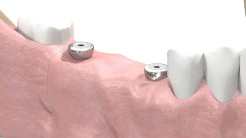 SIC-invent-Dental-Implant-Prosthetic-Animation-Bridge-Work-Open-Tray-Technique