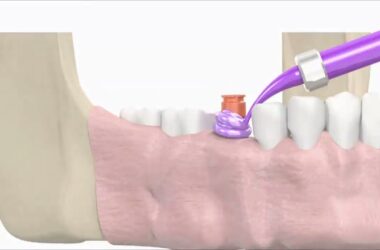 SIC-invent-Dental-Implant-Prosthetic-Animation-Single-Crown-Closed-Tray-Technique