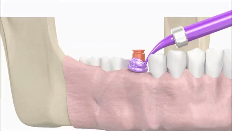 SIC-invent-Dental-Implant-Prosthetic-Animation-Single-Crown-Closed-Tray-Technique