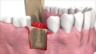 SIC-invent-Dental-Implant-procedure-SICmax-Implant
